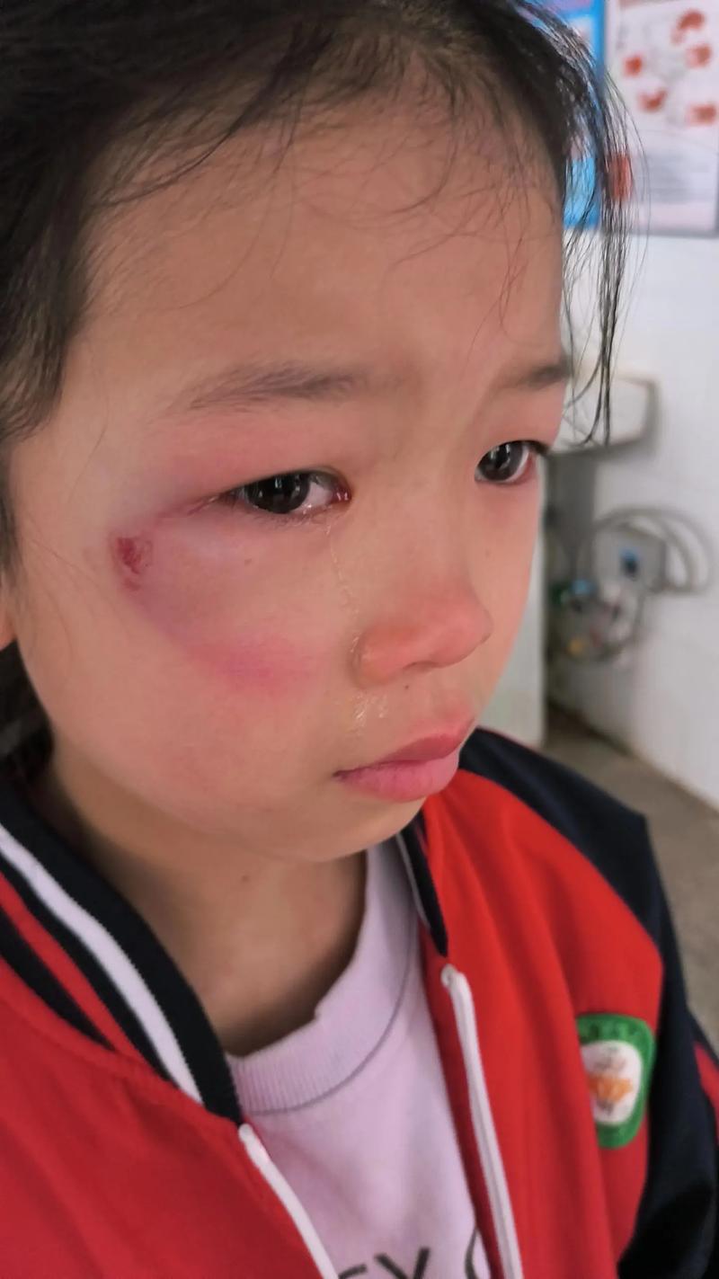 被精神病患挖伤双眼,被精神病患挖伤双眼怎么办