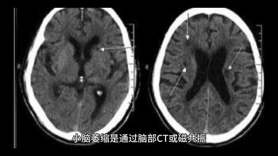送小脑萎缩儿子高考,小脑萎缩能上学吗